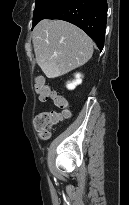 Cholecystoduodenal fistula due to calculous cholecystitis with gallstone migration (Radiopaedia 86875-103077 C 49).jpg