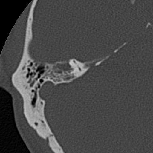 File:Cholesteatoma (Radiopaedia 15846-15494 bone window 4).jpg