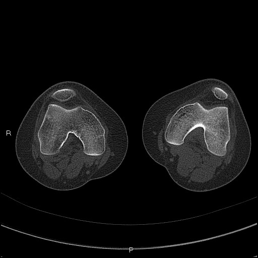 Chondroblastoma (Radiopaedia 62721-71030 Axial bone window 16).jpg
