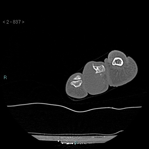 Chondrosarcoma - phalanx (Radiopaedia 69047-78812 Axial bone window 91).jpg