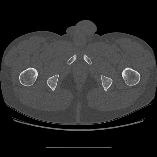 File:Chondrosarcoma of iliac wing (Radiopaedia 63861-72599 Axial bone window 125).jpg