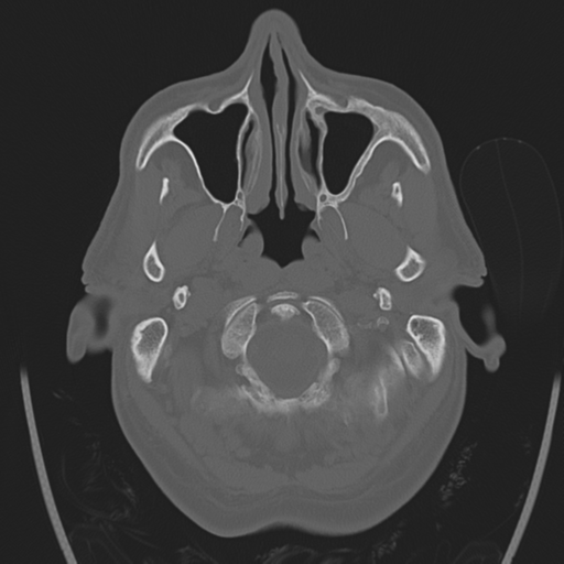 Chondrosarcoma of skull base- grade II (Radiopaedia 40948-43653 Axial bone window 2).png