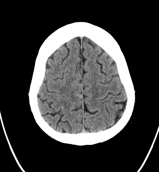 File:Chondrosarcoma of skull base- grade II (Radiopaedia 40948-43653 Axial non-contrast 24).png
