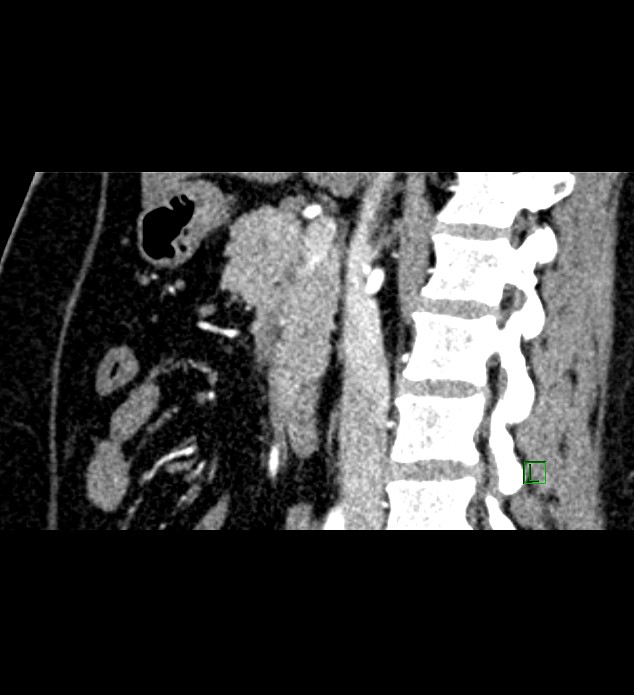 Chromophobe renal cell carcinoma (Radiopaedia 84286-99573 F 91).jpg