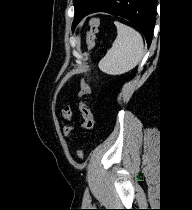 Chromophobe renal cell carcinoma (Radiopaedia 84286-99573 I 23).jpg