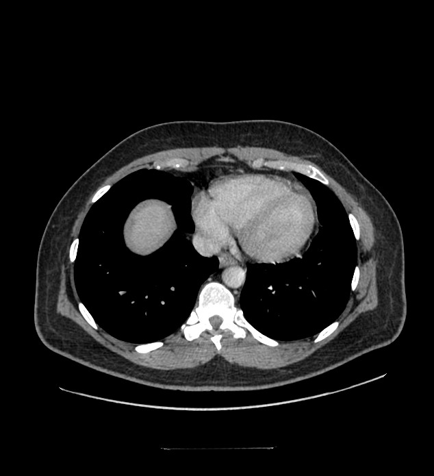 Chromophobe renal cell carcinoma (Radiopaedia 84337-99644 C 9).jpg