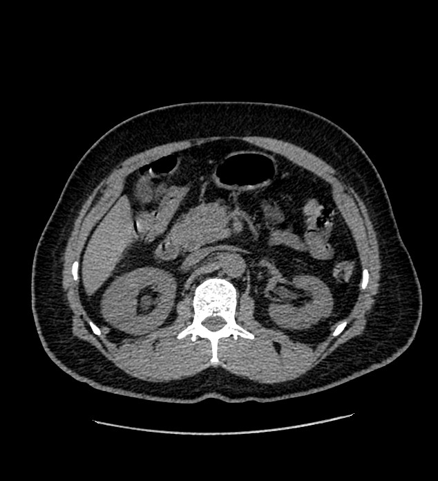 Chromophobe renal cell carcinoma (Radiopaedia 84337-99693 Axial non-contrast 48).jpg
