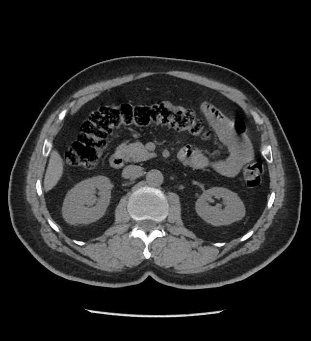 Chromophobe renal cell carcinoma (Radiopaedia 86879-103083 Axial non-contrast 38).jpg