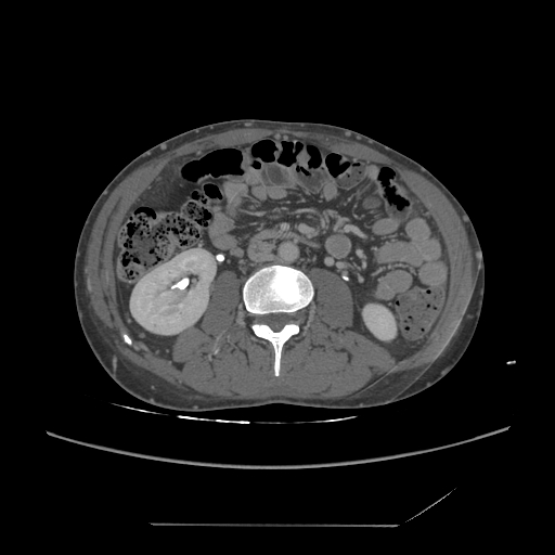 File:Chronic IVC thrombosis and resultant IVC filter malposition (Radiopaedia 81158-94800 A 109).jpg