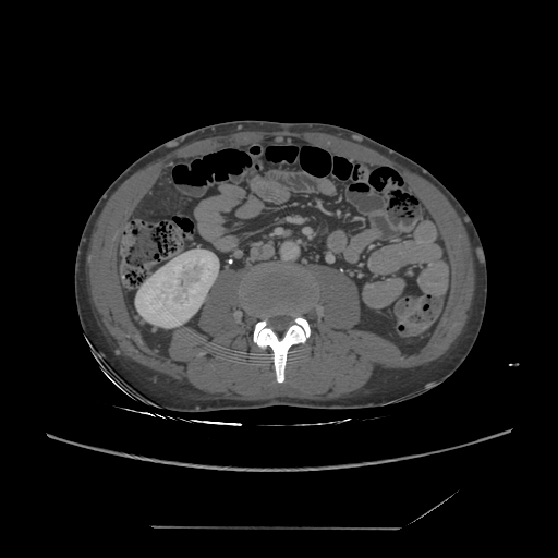 File:Chronic IVC thrombosis and resultant IVC filter malposition (Radiopaedia 81158-94800 A 117).jpg