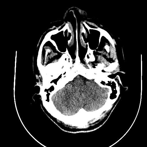 Chronic invasive fungal sinusitis (Radiopaedia 91563-109286 Axial non-contrast 11).jpg