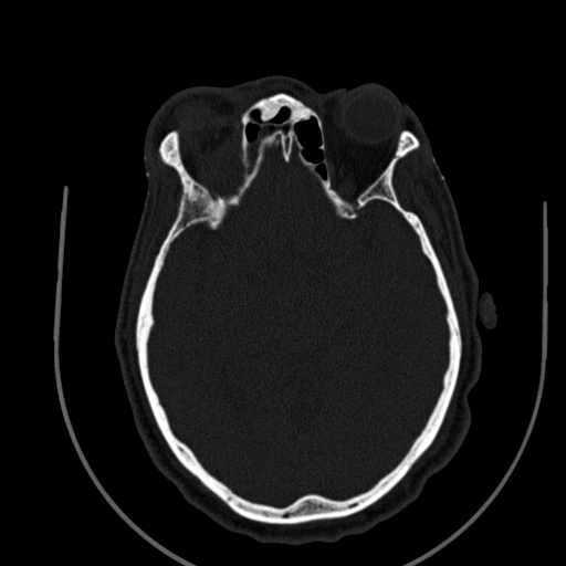 Chronic invasive fungal sinusitis (Radiopaedia 91563-109286 Axial sinus 107).jpg
