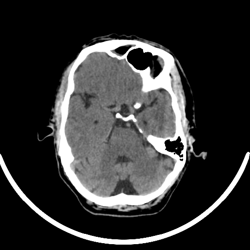 Chronic invasive fungal sinusitis with intraorbital and intracranial extension (Radiopaedia 56387-63046 Axial non-contrast 149).jpg