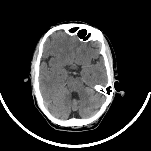 File:Chronic invasive fungal sinusitis with intraorbital and intracranial extension (Radiopaedia 56387-63046 Axial non-contrast 160).jpg