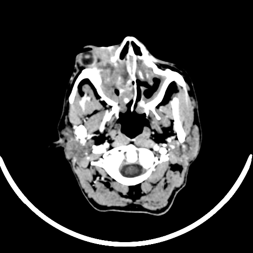 Chronic invasive fungal sinusitis with intraorbital and intracranial extension (Radiopaedia 56387-63046 B 43).jpg