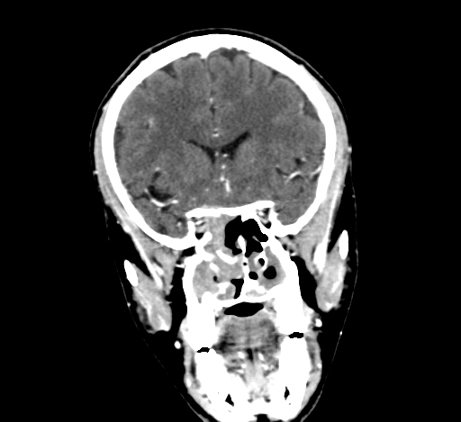 Chronic invasive fungal sinusitis with intraorbital and intracranial extension (Radiopaedia 56387-63046 C 143).jpg