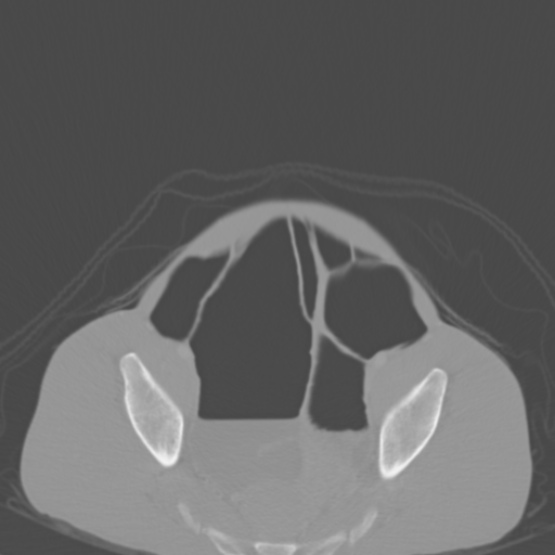 Chronic large bowel pseudo-obstruction (Radiopaedia 43181-46492 Axial bone window 144).jpg