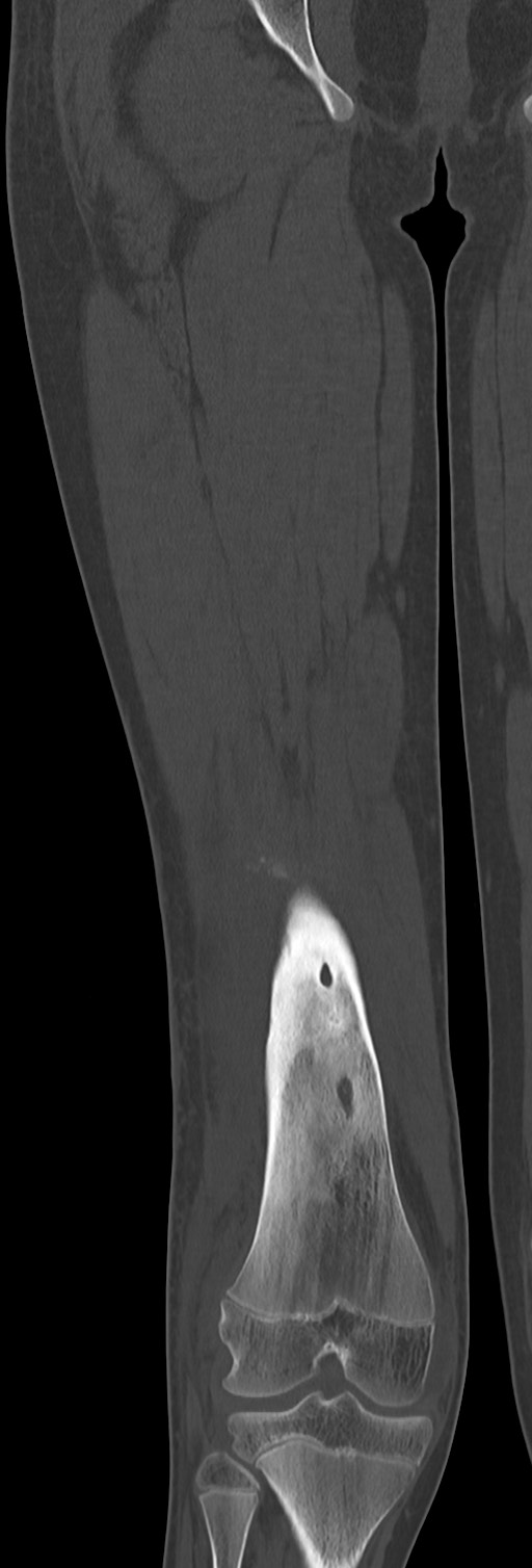 Chronic ostemyelitis of the femur with long sinus tract (Radiopaedia 74947-85982 Coronal bone window 49).jpg