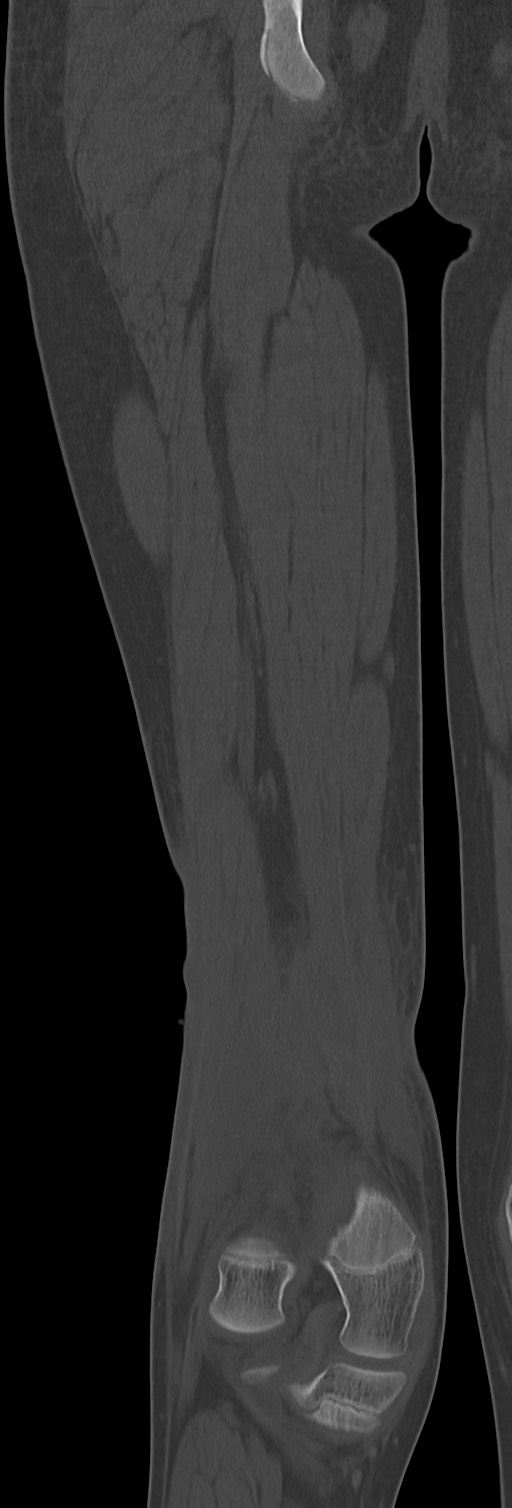 Chronic ostemyelitis of the femur with long sinus tract (Radiopaedia 74947-85982 Coronal bone window 56).jpg