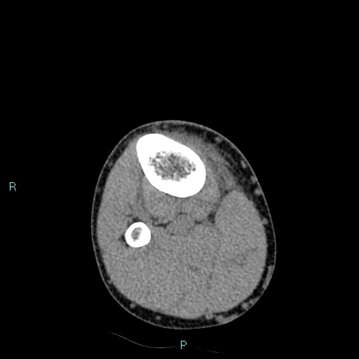 Chronic osteomyelitis (with Brodie abscess) (Radiopaedia 76405-88111 A 53).jpg
