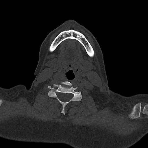 Chronic osteomyelitis - calvarial (severe) (Radiopaedia 69668-79616 Axial bone window 1).jpg