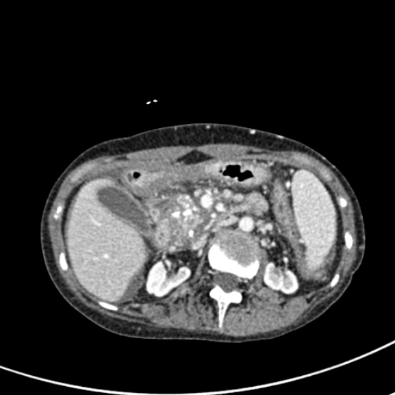 File:Chronic pancreatitis (Radiopaedia 55405-61846 A 40).jpg