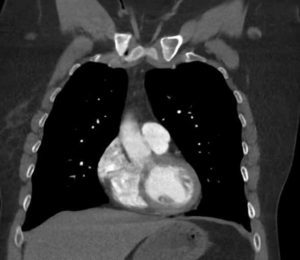 Chronic pulmonary embolus (Radiopaedia 39129-41341 Coronal C+ CTPA 32).png