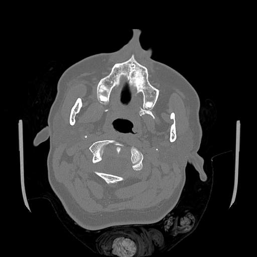 Chronic sinusitis with intra-sinus calcification (Radiopaedia 63919-72668 Axial bone window 83).jpg