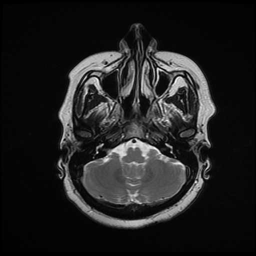 File:Chronic submandibular sialadenitis (Radiopaedia 61852-69885 Axial T2 2).jpg