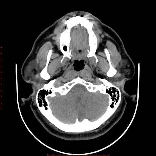Chronic submandibular sialolithiasis (Radiopaedia 69817-79814 Axial non-contrast 31).jpg