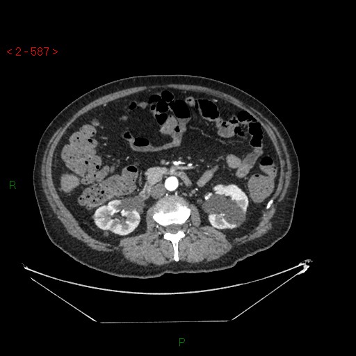 Circumaortic left renal vein and doubled left renal arteries (Radiopaedia 52268-58158 A 123).jpg