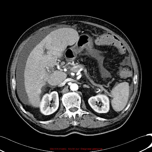 File:Cirrhosis and hepatocellular carcinoma in the setting of hemochromatosis (Radiopaedia 75394-86595 A 34).jpg