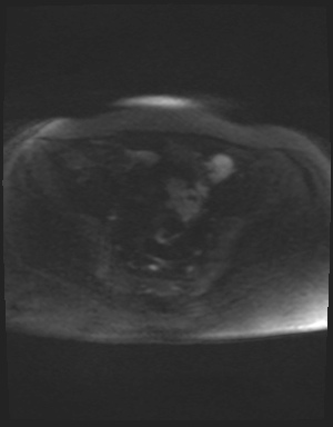 Class II Mullerian duct anomaly- unicornuate uterus with rudimentary horn and non-communicating cavity (Radiopaedia 39441-41755 Axial DWI 74).jpg