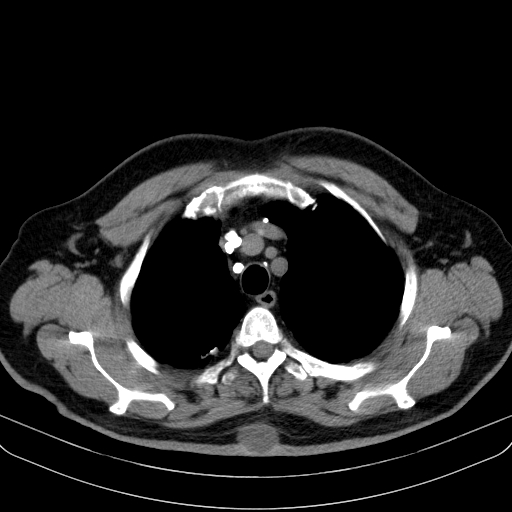 File:Classic complicated silicosis (Radiopaedia 49720-54961 Axial liver window 11).jpg