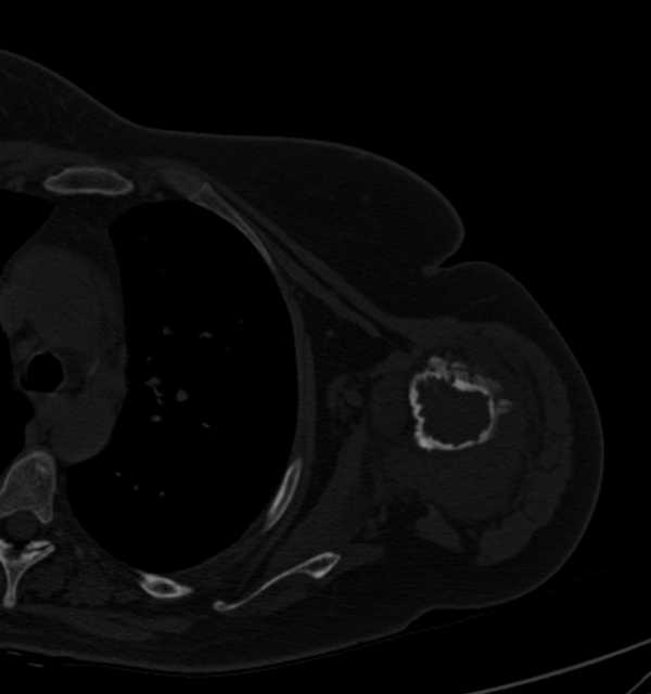 Clear cell chondrosarcoma - humerus (Radiopaedia 63104-71612 Axial bone window 61).jpg