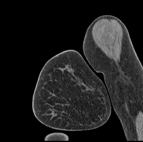 Clear cell chondrosarcoma - humerus (Radiopaedia 63104-71612 D 7).jpg