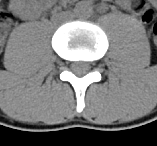 Clear cell meningoma - lumbar spine (Radiopaedia 60116-67691 Axial non-contrast 42).png