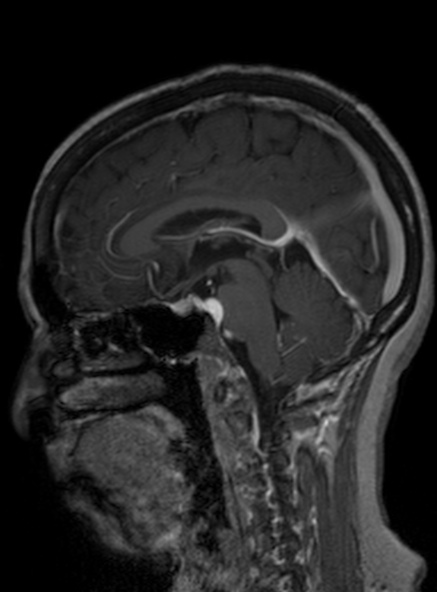 File:Clival meningioma (Radiopaedia 53278-59248 Sagittal T1 C+ 260).jpg
