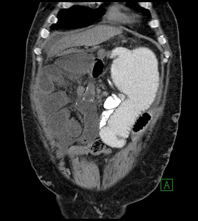 Closed-loop small bowel obstruction-internal hernia (Radiopaedia 78439-91096 Coronal non-contrast 28).jpg