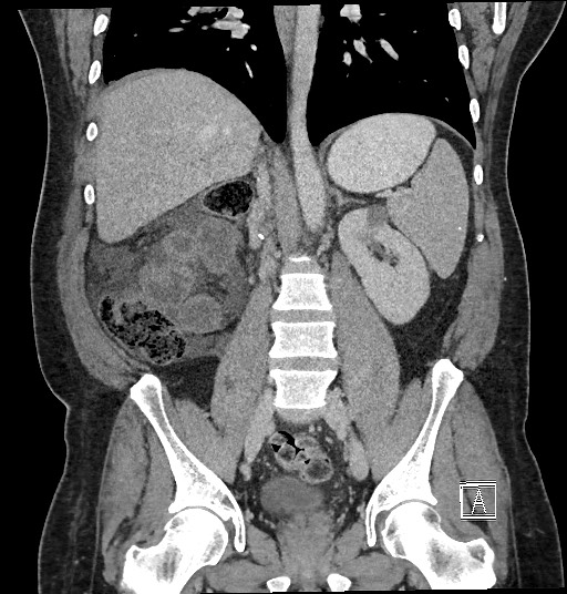 File:Closed loop obstruction - internal hernia into nephrectomy bed (Radiopaedia 59867-67320 B 85).jpg