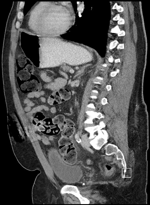 Closed loop obstruction - internal hernia into nephrectomy bed (Radiopaedia 59867-67320 C 35).jpg