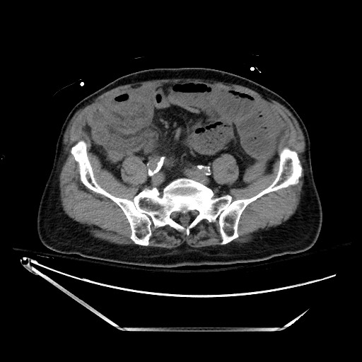 Closed loop obstruction due to adhesive band, resulting in small bowel ischemia and resection (Radiopaedia 83835-99023 Axial non-contrast 108).jpg