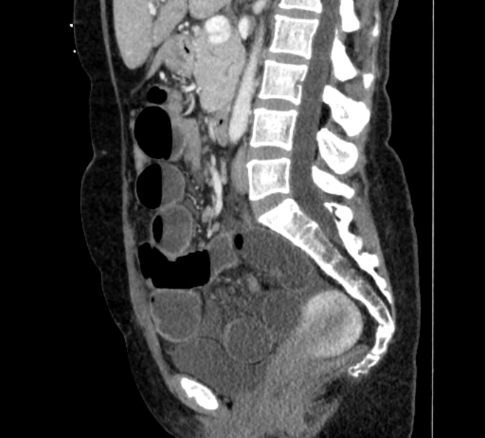 Closed loop small bowel obstruction (Radiopaedia 71211-81508 C 72).jpg