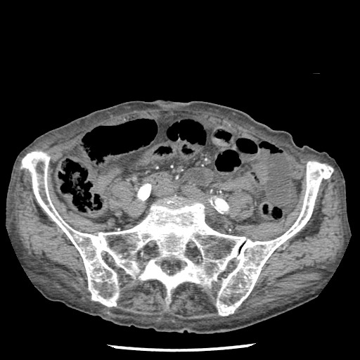 File:Closed loop small bowel obstruction - adhesions and infarct (Radiopaedia 85125-100678 A 128).jpg