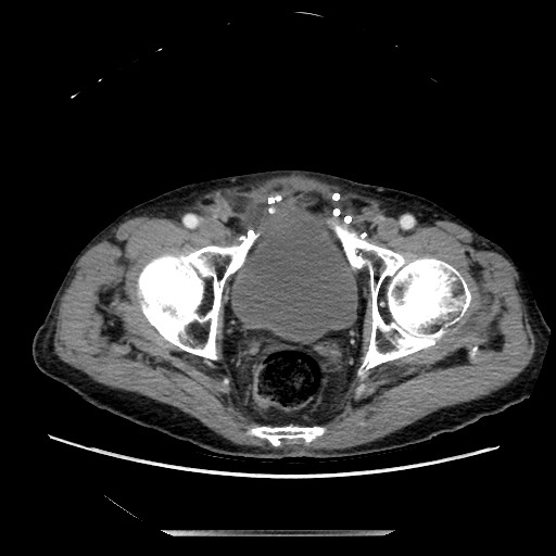 File:Closed loop small bowel obstruction - adhesive disease and hemorrhagic ischemia (Radiopaedia 86831-102990 A 164).jpg