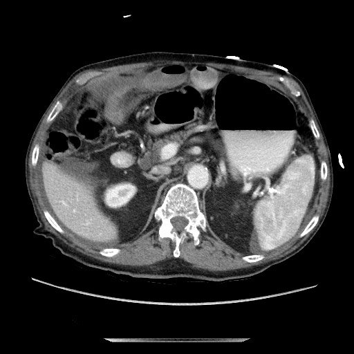 File:Closed loop small bowel obstruction - adhesive disease and hemorrhagic ischemia (Radiopaedia 86831-102990 A 66).jpg