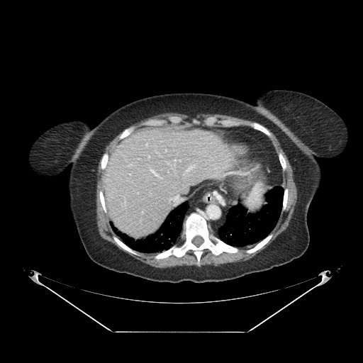 Closed loop small bowel obstruction - internal hernia (Radiopaedia 65402-74450 A 12).jpg