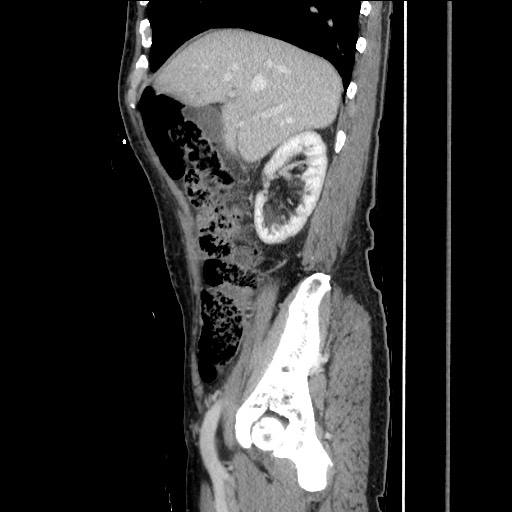 Closed loop small bowel obstruction - omental adhesion causing "internal hernia" (Radiopaedia 85129-100682 C 60).jpg