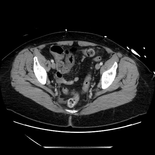 Closed loop small bowel obstruction due to adhesive bands - early and late images (Radiopaedia 83830-99014 A 133).jpg