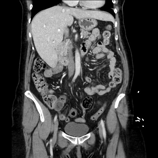 Closed loop small bowel obstruction due to adhesive bands - early and late images (Radiopaedia 83830-99014 B 55).jpg